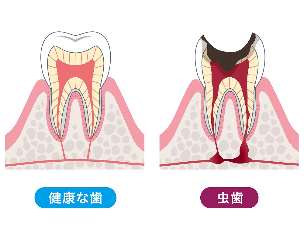 むし歯治療とは