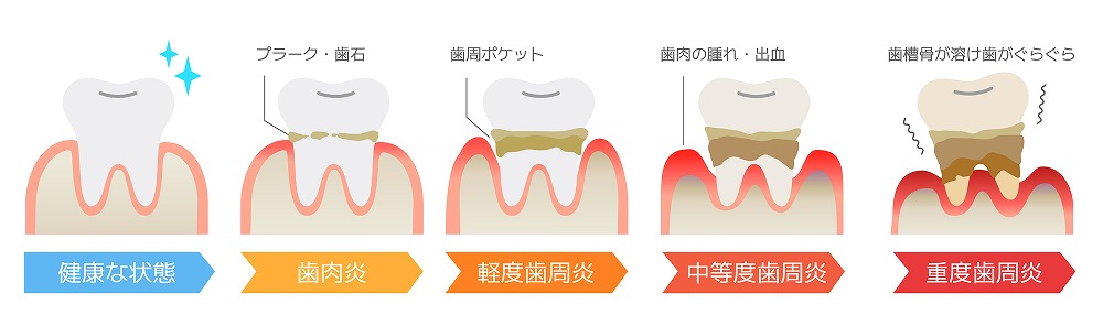 歯周ポケット検査