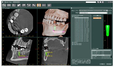 デジタル歯科用CTによる診査・診断
