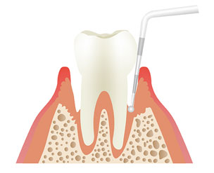 歯周ポケット検査